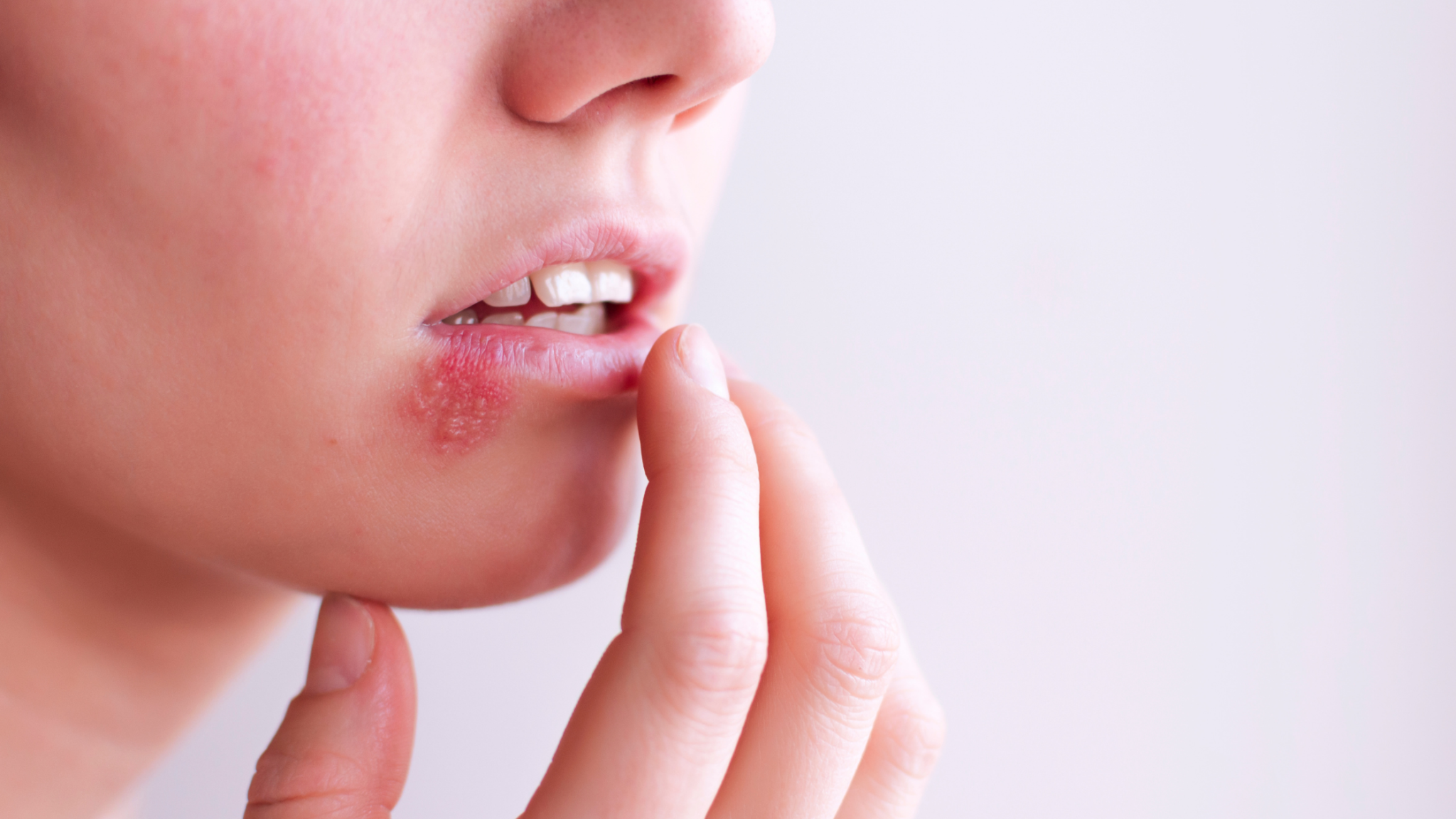 OAS vs Food Allergy - Wisconsin Food Allergy - Dr Ringwala